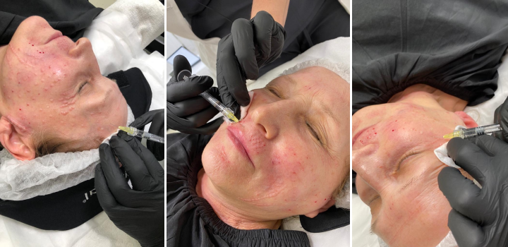 papules.png papules.png